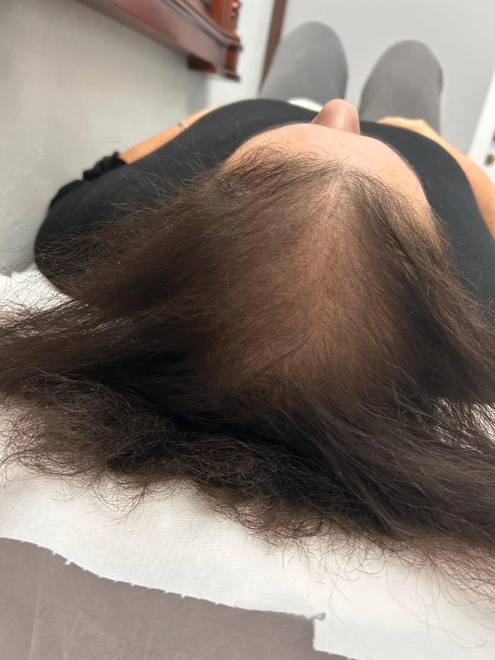 Alopecie androgenică feminină Vertex — rarefiere severă, vedere laterală cabinet TRICOEXPERT Iași